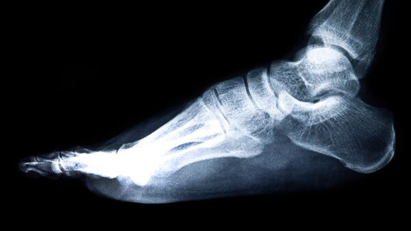 Рентгеновский снимок ноги, архивное фото - Sputnik Литва