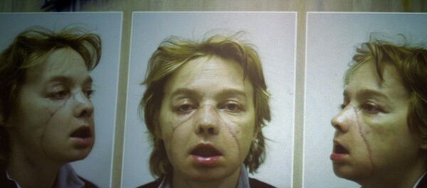 Француженка Изабель Динуар, ставшая первым в мире человеком, которому были частично пересажены ткани лица - Sputnik Литва