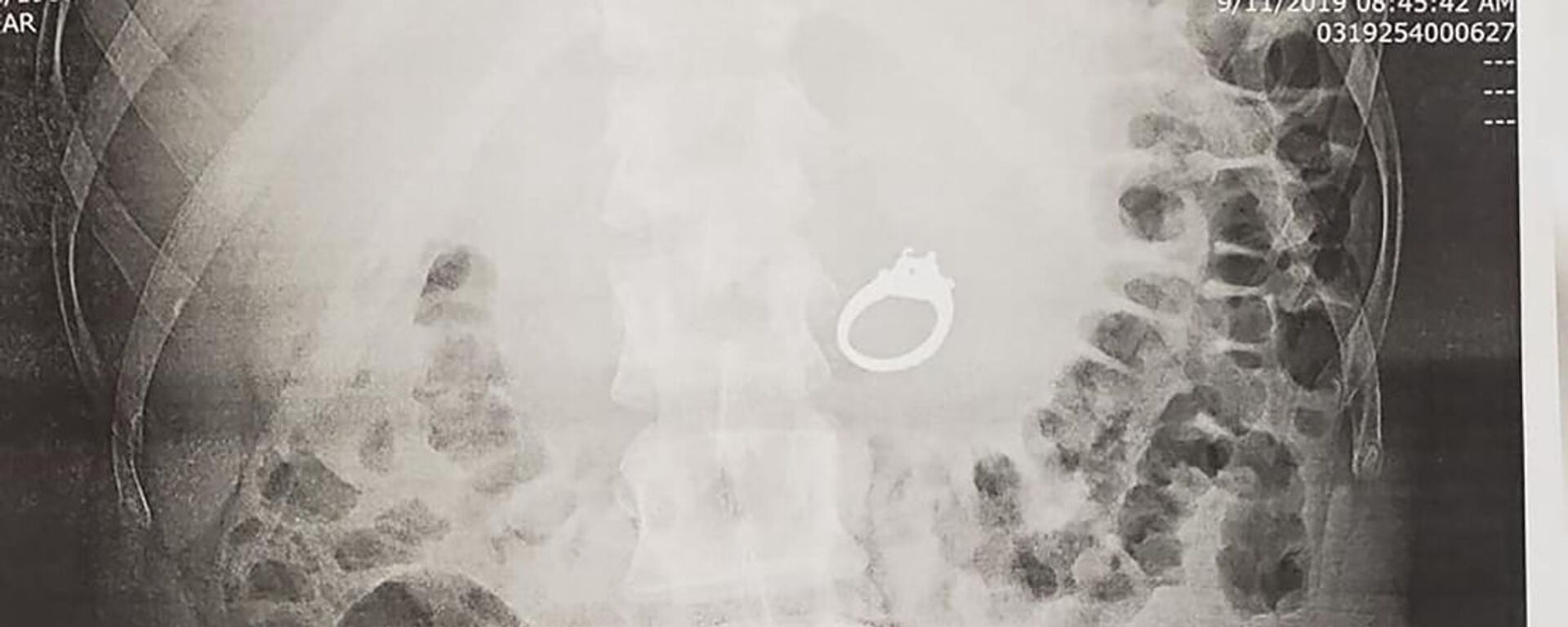 Американка проглотила кольцо, испугавшись приснившихся грабителей - Sputnik Lietuva, 1920, 16.09.2019