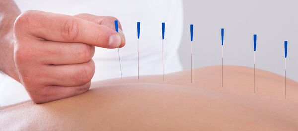 Иглотерапия, архивное фото - Sputnik Литва