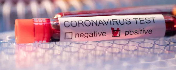 Образец крови с положительным тестом на коронавирус - Sputnik Lietuva