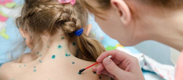 Девочка, болеющая ветрянкой Девочка, болеющая ветрянкой - Sputnik Lietuva