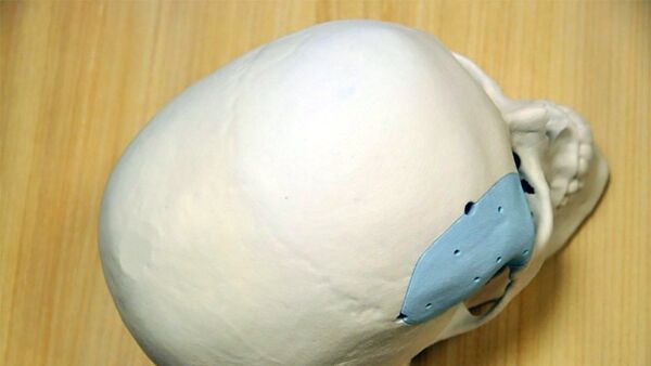 Модель протеза части черепа - Sputnik Литва