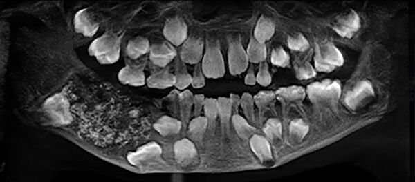 Зубы во рту 7 летнего мальчика из Индии, пациента Saveetha Dental College and Hospital - Sputnik Lietuva